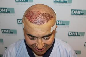 Post Hair Transplant Procedure - DHI