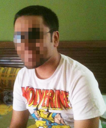 Before Hair Transplant