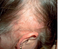 Scarring Alopecia