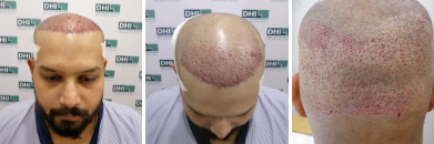Vaibhav Rawal’s Hair Transplant Surgery