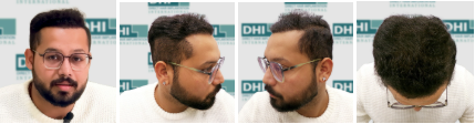 Vaibhav Rawal’s AfterHair Transplant 