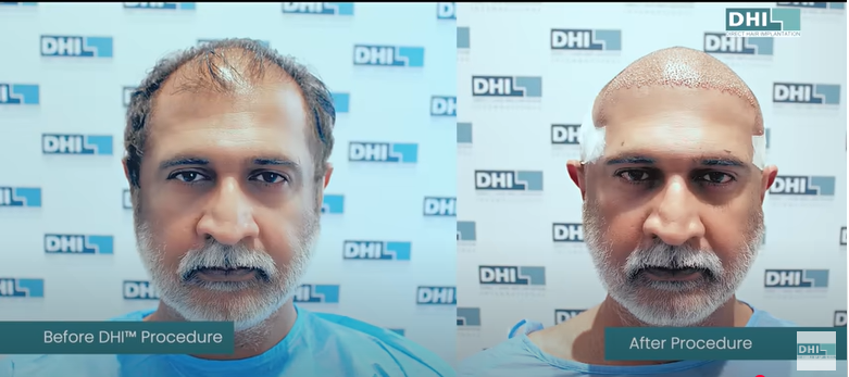 Adithya Menon Before DHI and After Procedure