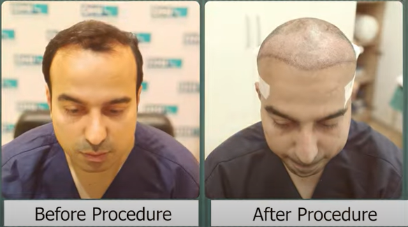 Vatsalya Mehrotra before and after hair transplant