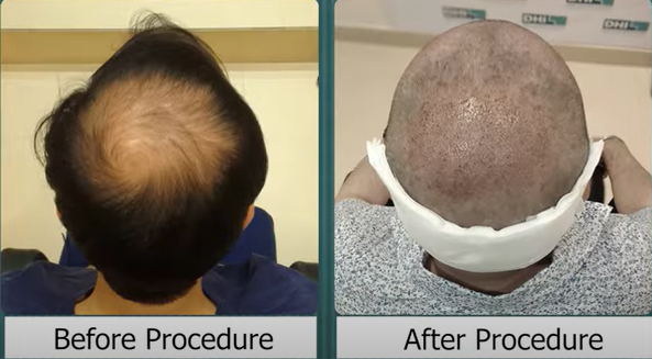 Before and after procedure