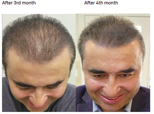 Hair Transplant Growth Signs in 3 to 4 Months