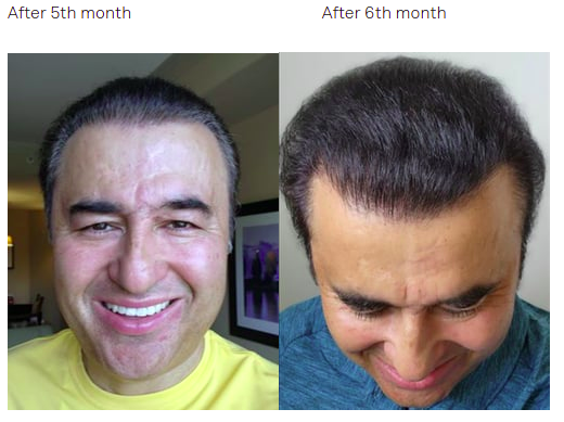 Hair Transplant Growth Signs in 5 to 6 Months