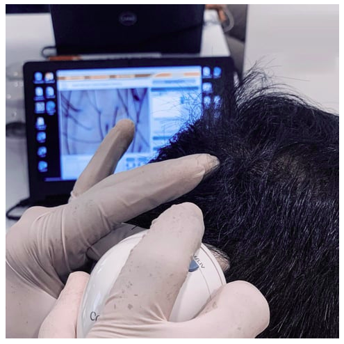 Computerized Alopecia Tests