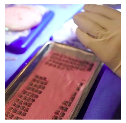 Hair Transplant Procedure