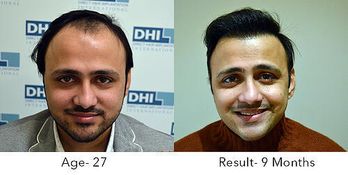 Hair Transplant Results After 9 Months