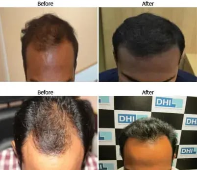 Hair Loss - Before & After Images