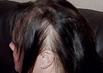 Trichotillomania