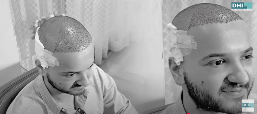 After Hair Transplant