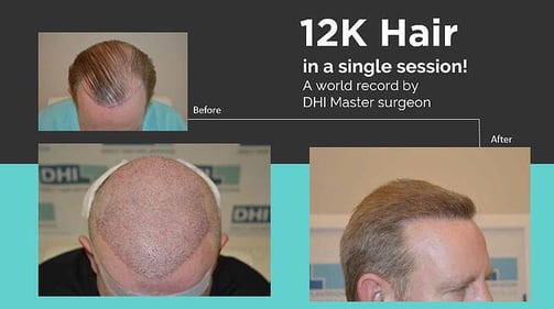 DHI Surgeon World Record - 12k Hair in a Session