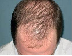 Androgenetic Alopecia