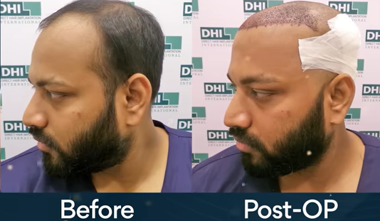 Hair transplantation before and after