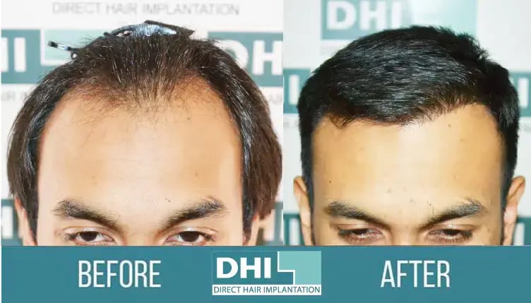 DHI Hair Transplant Clinics Surgery