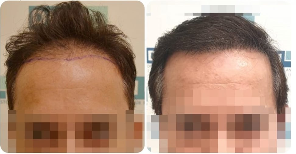 hair transplant results- DHI