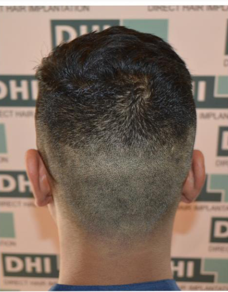 Donor Area After a DHI Hair Transplant Procedure