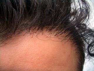 Results After an FUE Surgery