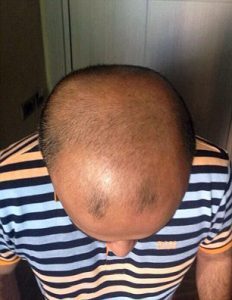 Faisal Hamid Before Hair Transplant