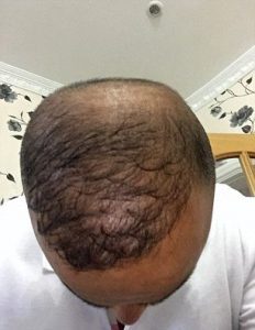 Faisal Hamid Before and After Hair Transplant Treatment
