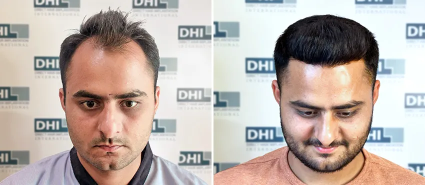 Hair Transplant in delhi
