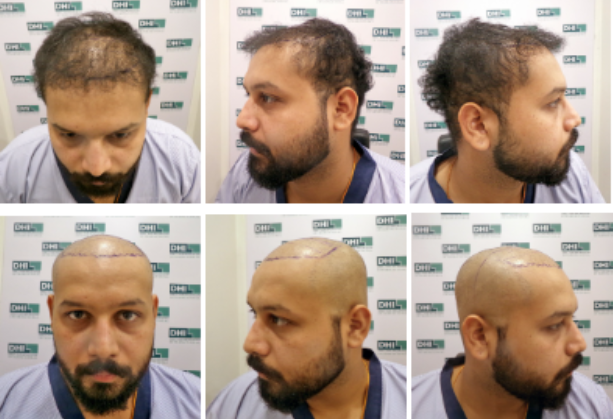 DHI Hair Transplantation Procedure