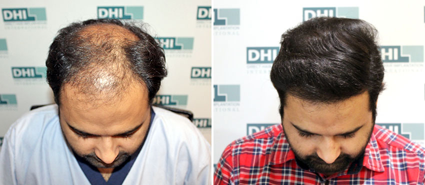 Hair transplants 
