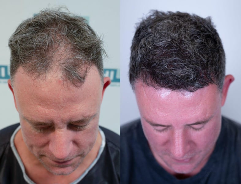 Wayne Bridge After Hair Transplant Surgery