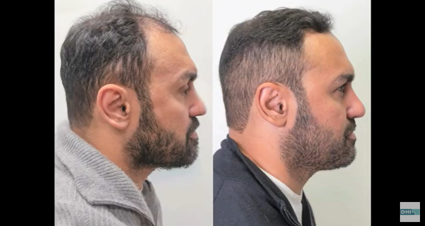 Hair Transplant Results