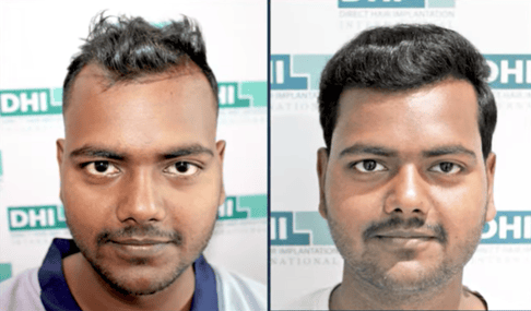 Hair Transplant results