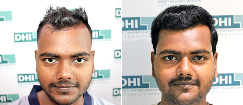 Hair Transplant before and after results