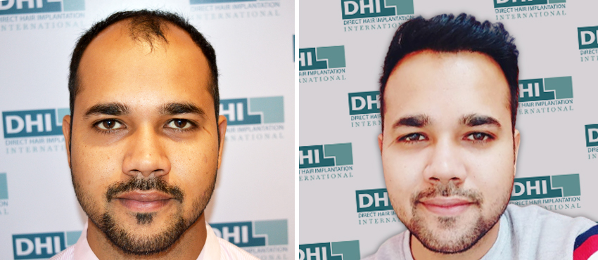 Hair Transplant Before and After