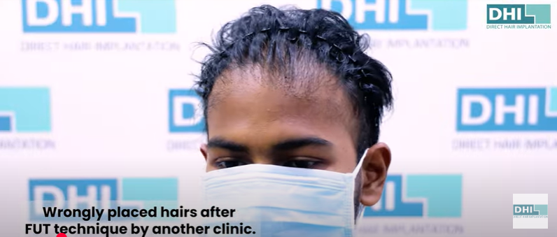 Mr. Manoj Kumaran Before Hair Transplant