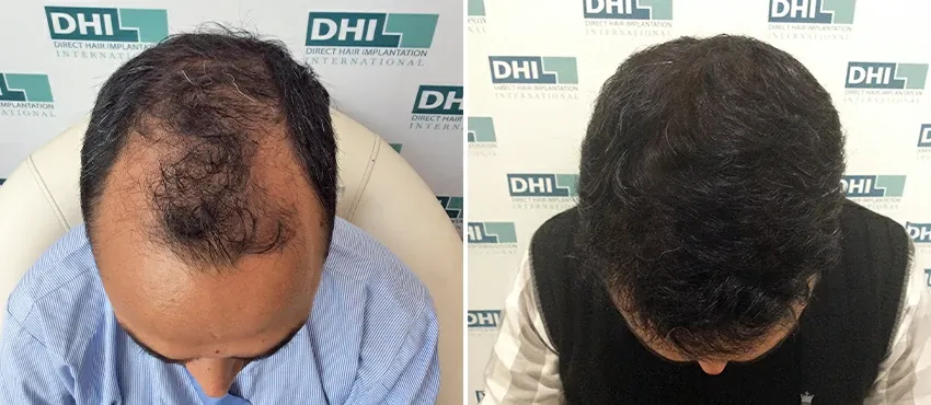 Hair transplant results in delhi