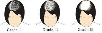 Female Pattern Hair Loss
