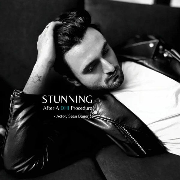 Actor. Sean Banerjee hair transplant