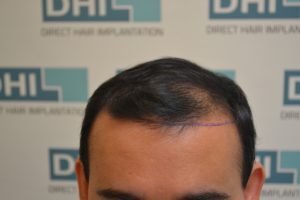 Dr. Sachin Dhawan before Hair Transplant