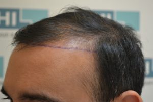 Dr. Sachin Dhawan before Hair Transplant Process