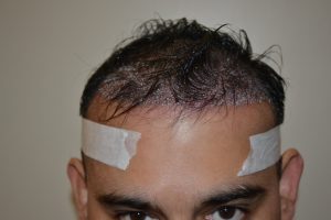 Dr. Sachin Dhawan before Hair Transplant Procedure