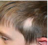 Triangular Alopecia