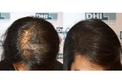 Female Hair Loss Treatment 