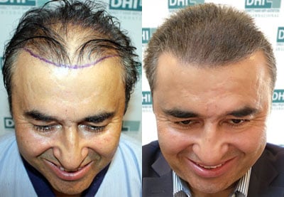 Before & After Hair Transplant Results