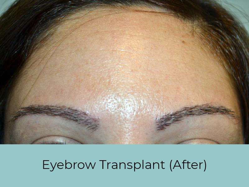eyebrow-after