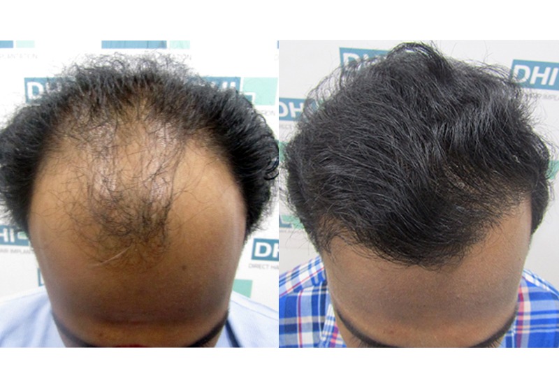 DHI Happy Patient Hair Transplant Result
