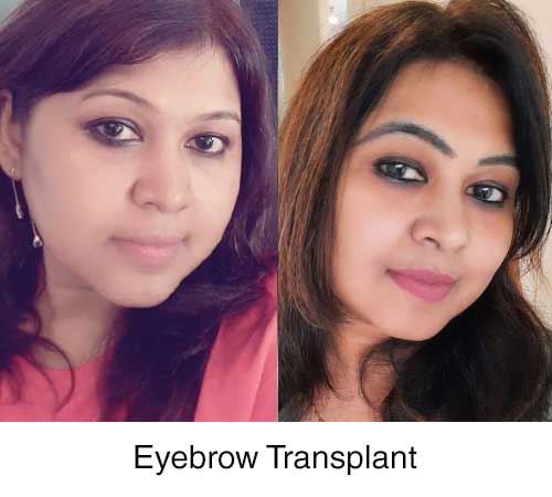 Female Hair Loss Transplant and Eyebrow Restoration
